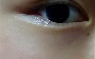 滴泪痣