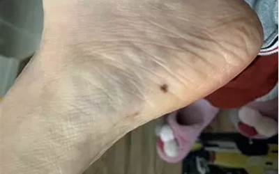 脚后跟有痣