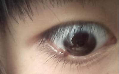 眼睑有痣