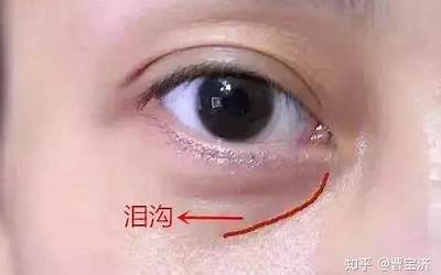 为什么会有泪沟