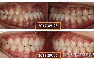 地包天要怎么矫正