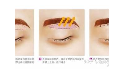 眉上提(什么是眉毛上提术)
