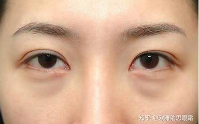 眼袋纹(怎么样除掉眼袋皱纹)